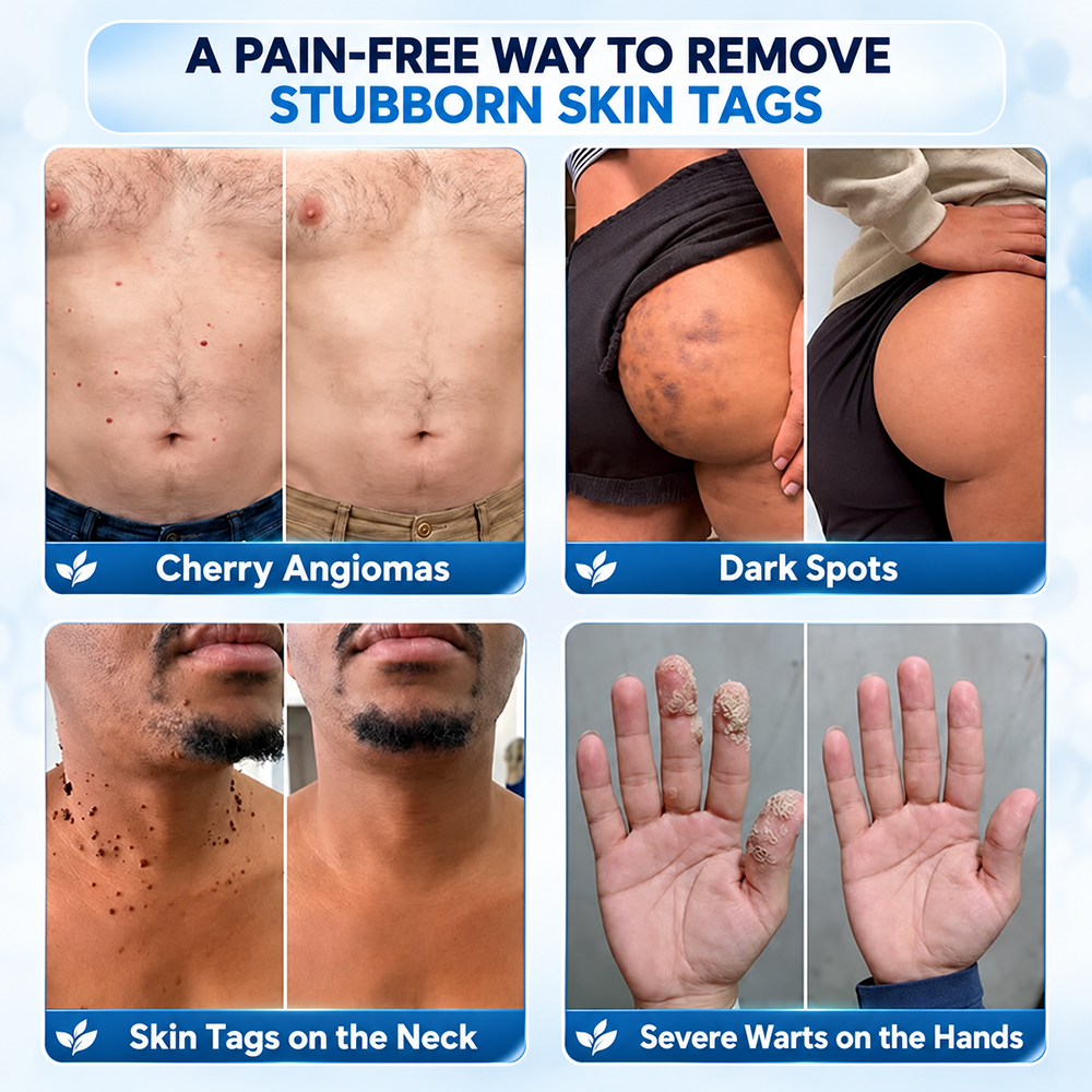 TERVENCE® 🧑 ⚕️ 7-Day Cream for Skin Growths & Pigmentation Spots (painless formula – scar-free)🌿2️⃣ — image 3