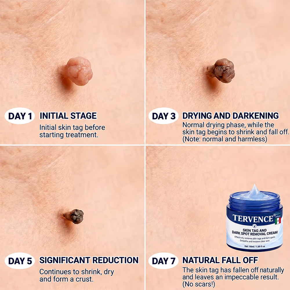 TERVENCE® 🧑 ⚕️ 7-Day Cream for Skin Growths & Pigmentation Spots (painless formula – scar-free)🌿2️⃣ — image 4