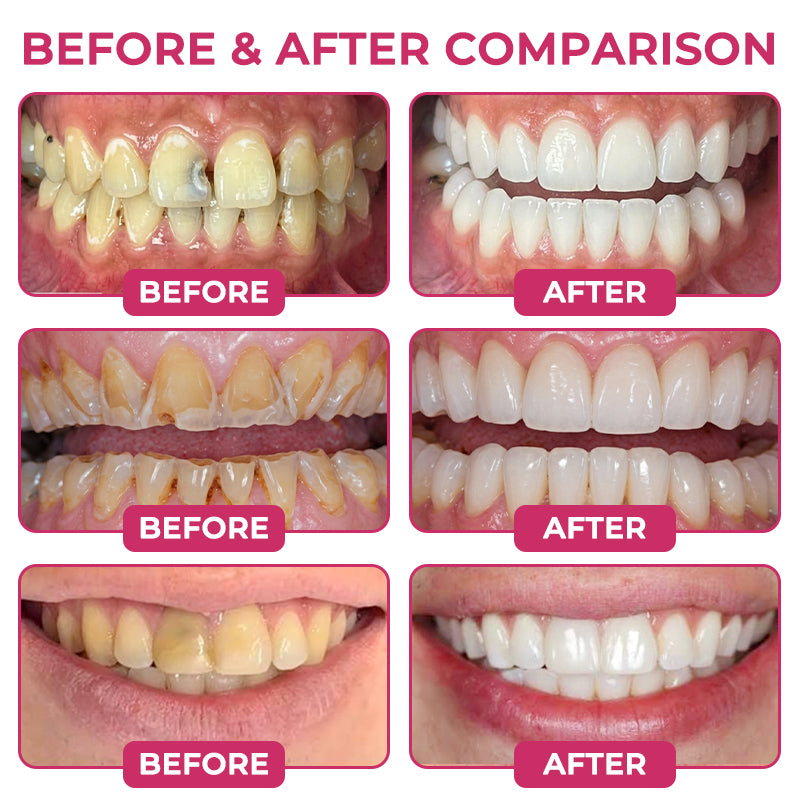TERVENCE®Cavity-Repair Natural Enamel Filling Gel — image 3