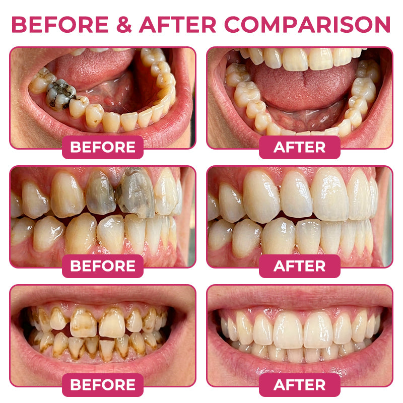 TERVENCE®Cavity-Repair Natural Enamel Filling Gel — image 2